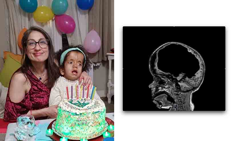 RNA Therapy May Be a Solution for Infant Hydrocephalus